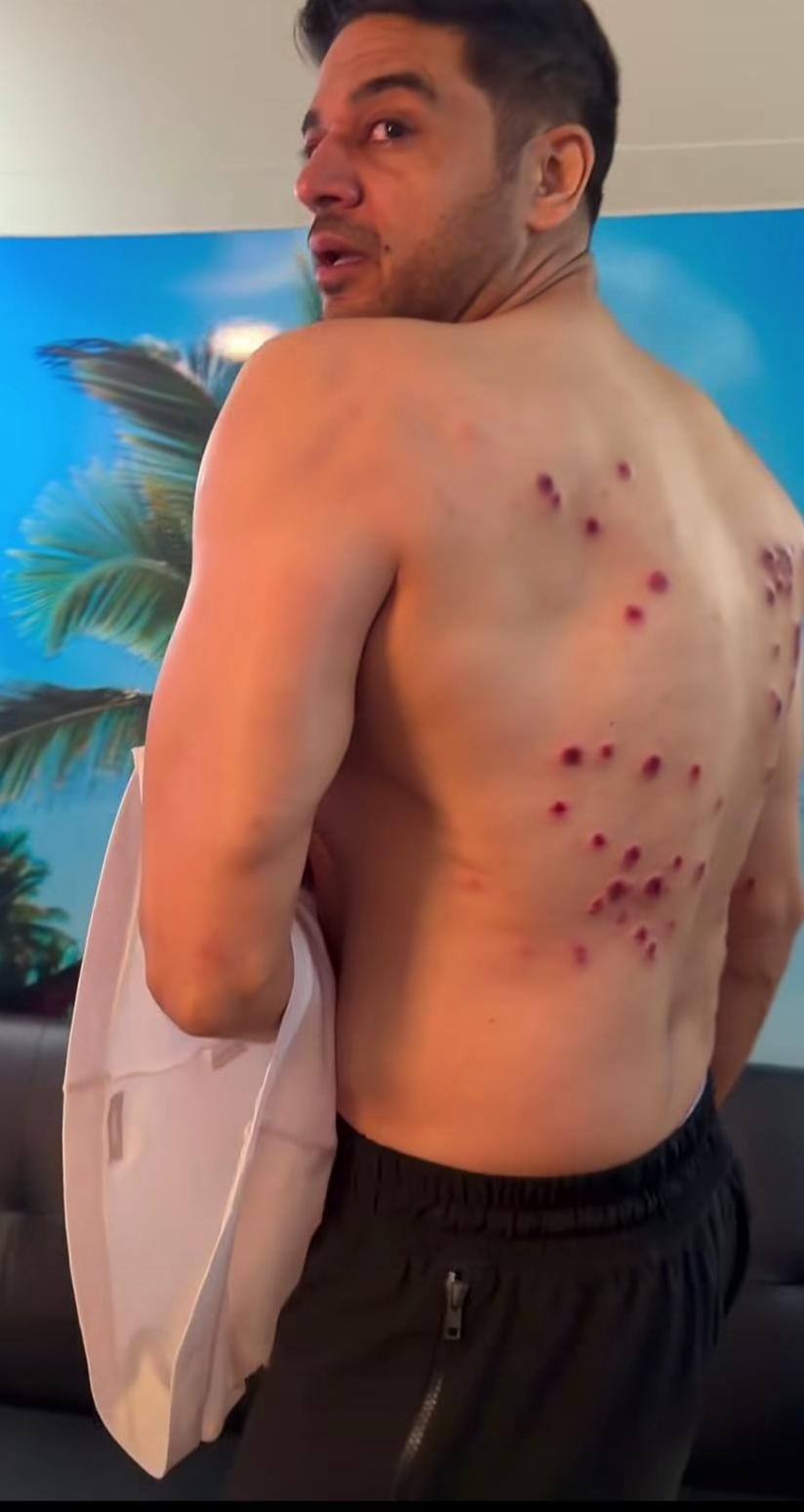 Gaurav Khanna shows painful laser burn marks on his back from 'Khatron Ke Khiladi' task