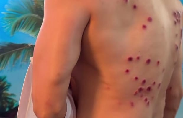 Gaurav Khanna shows painful laser burn marks on his back from 'Khatron Ke Khiladi' task
