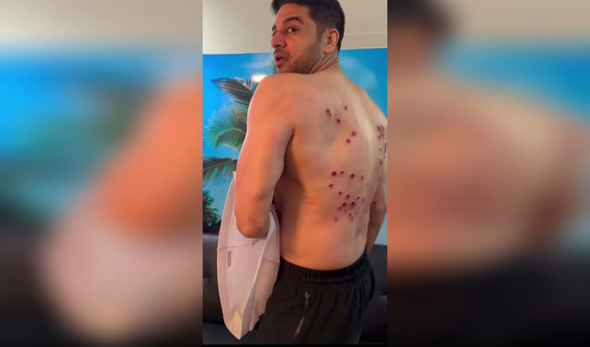 Gaurav Khanna shows painful laser burn marks on his back from 'Khatron Ke Khiladi' task